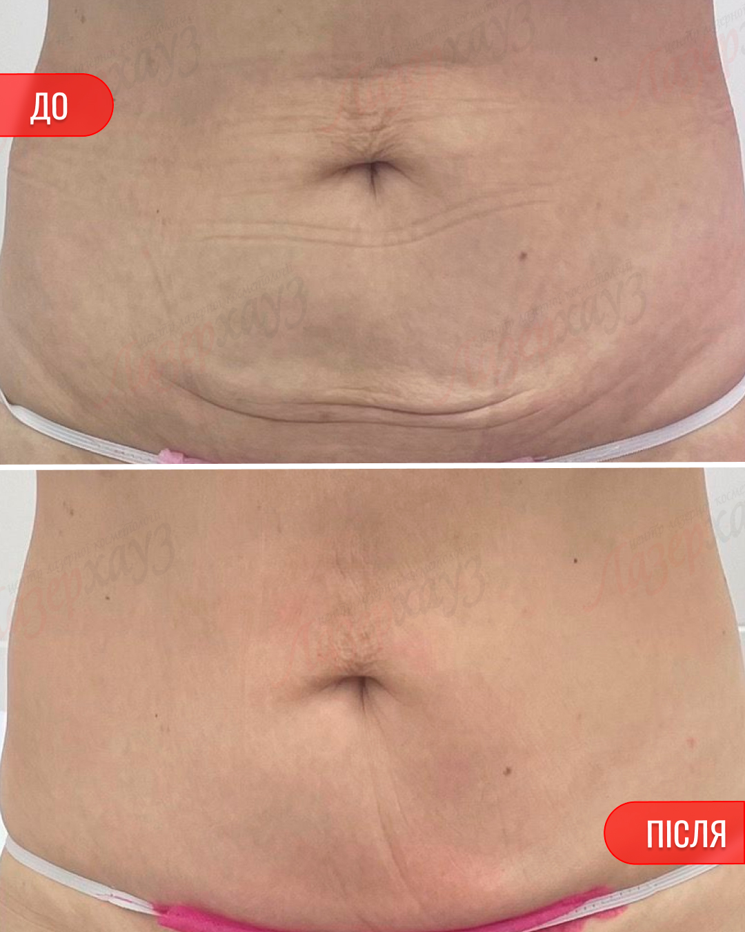 До і після — живіт